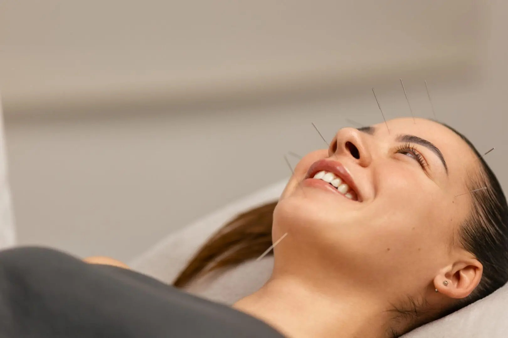 A person lies down with acupuncture needles placed on their face, smiling gently during a treatment session.