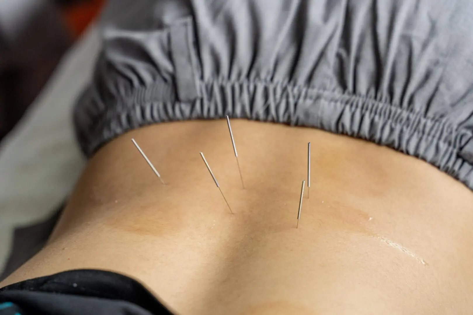 Close-up of acupuncture needles inserted into a person's lower back. The person is lying down, wearing grey pants.