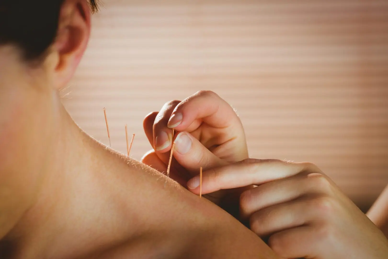 A person receives acupuncture on the shoulder, with multiple thin needles inserted into the skin. The practitioner's hands are visible adjusting a needle.