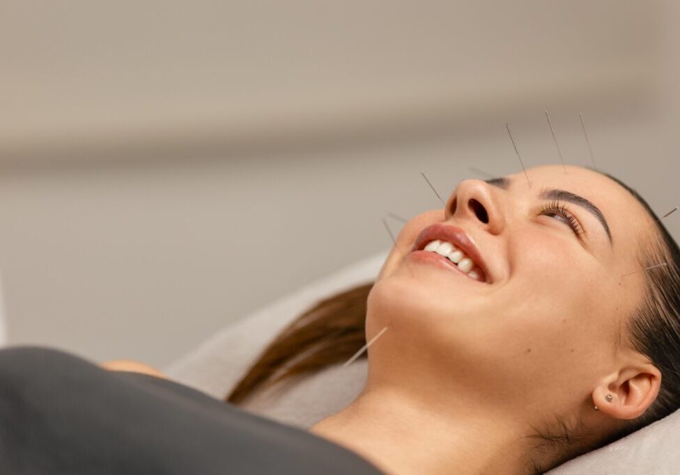 A person lies down with acupuncture needles placed on their face, smiling gently during a treatment session.