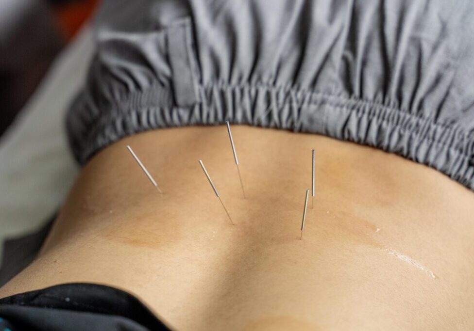 Close-up of acupuncture needles inserted into a person's lower back. The person is lying down, wearing grey pants.
