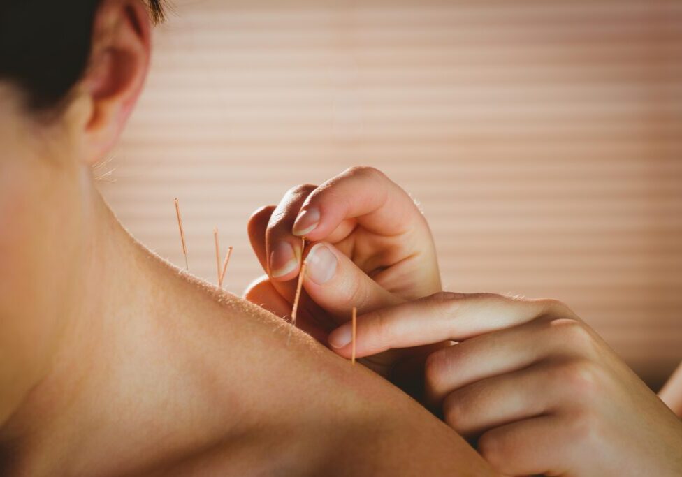 A person receives acupuncture on the shoulder, with multiple thin needles inserted into the skin. The practitioner's hands are visible adjusting a needle.